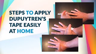 Dupuytren’s Tape Training  Dupuytrens Contracture Home Treatment [upl. by Aggi]