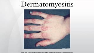 Dermatomyositis [upl. by Ttenaj879]