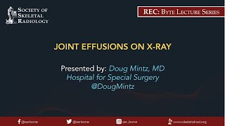 Joint Effusions on XRay [upl. by Aitam]