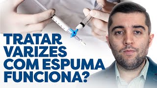 Mitos e verdades ao tratar varizes cirurgia espuma laser qual é melhor Varizes podem voltar [upl. by Amada]