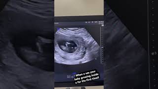 14 weeks baby growing inside the womb baby gynaecologist ultrasound pregnancyultrasound [upl. by Anilag688]