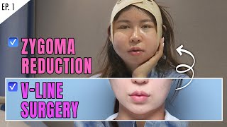 SUB Zygoma and Jawline Reduction Plastic Surgery Review VLOG in KOREA  SLIM amp VLINE FACE [upl. by Nuahsal794]