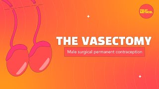 Vasectomy FAQs 🧐❓ [upl. by Werbel856]