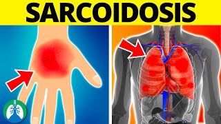 Sarcoidosis Medical Definition  Quick Explainer Video [upl. by Blainey]