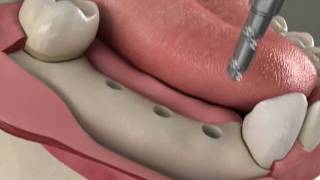 Dental Implants  Implant bridge in Denville NJ [upl. by Loux]