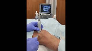 PRP knee injection under ultrasound guidance [upl. by Ainirtak144]