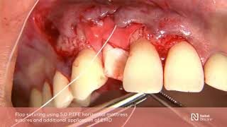 Guided bone regeneration with simultaneous implant placement [upl. by Igiul]