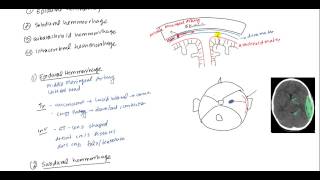 Epidural Hematoma Subdural hematoma Subarachnoid hematoma Intracerebral hemorrhage [upl. by Lydon481]