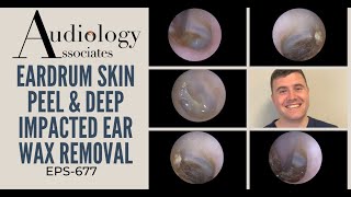 EARDRUM SKIN PEEL amp DEEP IMPACTED EAR WAX REMOVAL  EP677 [upl. by Eilraep695]