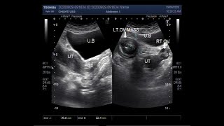 Ultrasound Video showing Two cases one of Ovarian Mass and the other of Ovarian Cyst [upl. by Aiva]