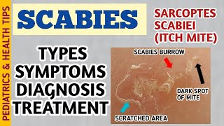 Scabies Classic Crusted Nodular Scabies Symptoms Diagnosis and Treatment  Itch Mite [upl. by Sommers]