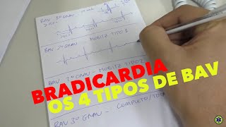 BRADIARRITMIAS BLOQUEIOS ÁTRIOVENTRICULARES BAV  ACLS [upl. by Adest]