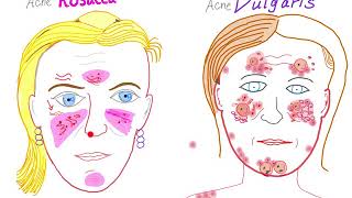 Acne Vulgaris Vs Acne Rosacea [upl. by Omura777]