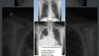 Chest PA 흉부 xray Quiz  8 Paratracheal stripe thickening shorts [upl. by Brennan728]