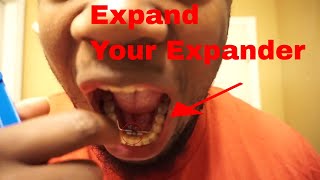 How To TURN Braces Expander [upl. by Llewellyn]