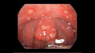 Acute Ulcerative Pharyngitis Causing Severe Sorethroat [upl. by Fred]