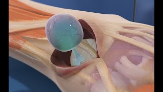 Ganglion Cyst Removal 3D Animation [upl. by Howell345]