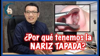 6 CAUSAS más comunes de OBSTRUCCIÓN NASAL y como resolverlo  PlasticFacial MX [upl. by Lira]