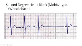 Second Degree Heart Block Mobitz type 1Wenckebach [upl. by Atilehs]