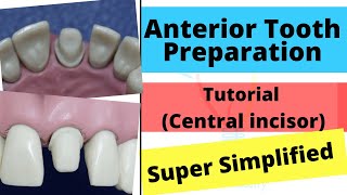 Anterior Crown Preparation  Demonstration Super Easy [upl. by Qifar]