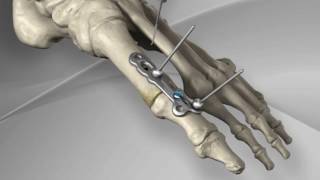 First Metatarsophalangeal Joint Fusion with Arthrex® MTP Fusion Plate [upl. by Enialedam]