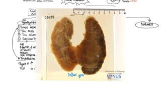 Thyroid Pathology Clinicopathologic Correlations [upl. by Olwena653]