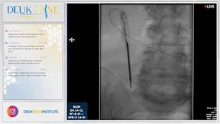 Laser Spine Surgery  Herniated Disc  Back Pain  BL L4L5 RT L5S1 [upl. by Euell]