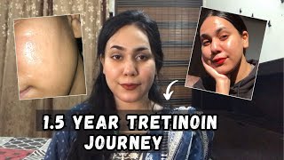 Tretinoin Journey 15 Year  Shamaim Rajpoot [upl. by Alger840]