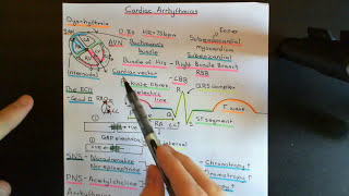 Cardiac Arrhythmias Part 4 [upl. by Aicert404]