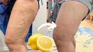 Lemon Removes Varicose Veins This Is What You Need To Do [upl. by Otecina]