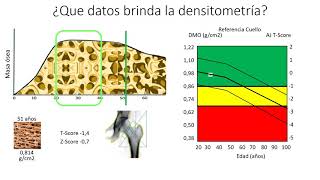 Densitometría e imagenes salud ósea en el climaterio [upl. by Marigold]