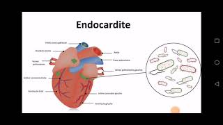 Lendocardite infectieuse [upl. by Anaili]