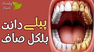 Top Effective Home Remedy to Remove Plaque and Tarter  Get rid of Dental Plaque at Home [upl. by River]