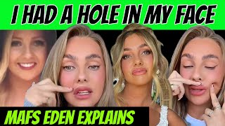 MAFS EDEN 👄 explains what really happened to her lips and the hole in her face [upl. by Ruperta]