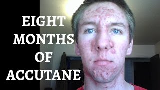 Severe Cystic Acne  Timelapse Version 1 [upl. by Aja513]