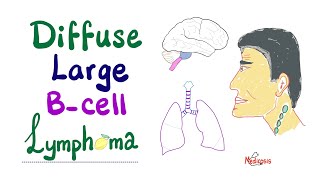 Diffuse Large BCell Lymphoma  Diagnosisamp Treatment  Aggressive BCell NonHodgkin’s Lymphoma [upl. by Tybald47]