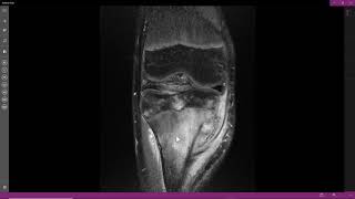 Osteomielite crônica com abscesso de Brodie [upl. by Nichani345]