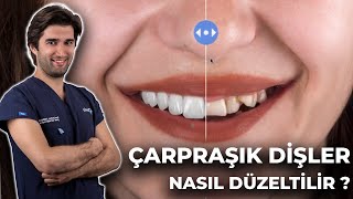 ÇARPRAŞIK DİŞLER NASIL DÜZELTİLİR [upl. by Munmro]