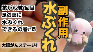 大腸がんステージ4 副作用水ぶくれ 抗がん剤2回目足の裏に水ぶくれできるの巻15 抗がん剤副作用水ぶくれ大腸がん大腸がんステージ4ステージ4がんがんユーチューバがんサバイバー [upl. by Kovacev]