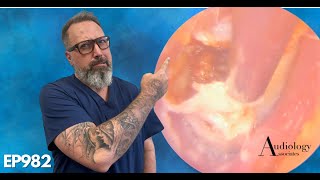 Most Satisfying Ear Wax And Thick Dead Skin Removal From Ear   EP982 [upl. by Assi]