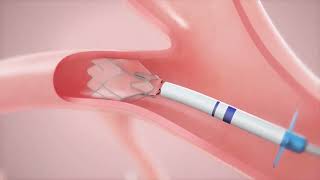 How It Works Zephyr Endobronchial Valve for Those with COPD amp Emphysema [upl. by Marsha]