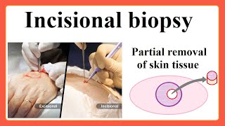 incisional biopsy [upl. by Ik]