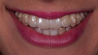 Invisalign Caso Clinico con grave affollamento [upl. by Merola]