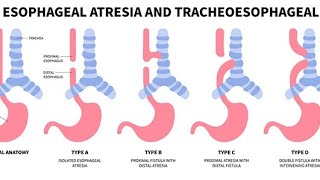 TRACHEOESOPHAGEAL 🫁FISTULA TEFESOPHAGEAL ATRESIA👍🏻HINDI msnpediatrics tracheoesophagealfistula [upl. by Boggs528]