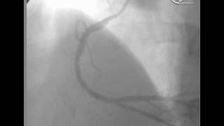 angioplastia en Infarto Agudo [upl. by Jennilee]