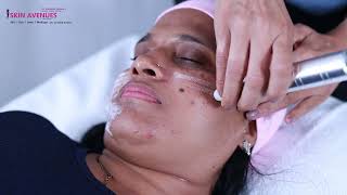 Medifacial at Skin Avenues Clinic kharadi Pune Hydrafacial in Pune [upl. by Nahseez]