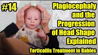 14 Plagiocephaly and the Progression of Head Shape Explained Torticollis Treatment in Babies [upl. by Ennovahs]