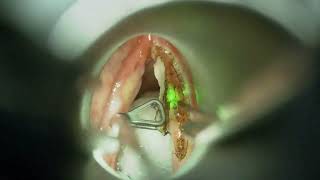 Type 1 Cordectomy By Using TrueBlue Laser [upl. by Adhern]