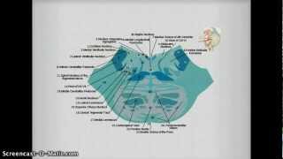 Medial Inferior Pontine Syndrome pics [upl. by Lucienne]