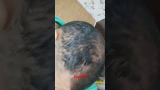 Hair transplant day 120 hairlinetransplant viralvideo shortvideo viralvideo shorts [upl. by Myrna]